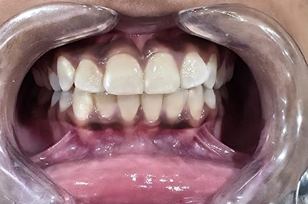 Straightened teeth after clear aligner treatment in Lucknow