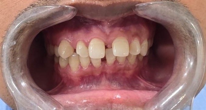 Clear aligner patient result at Nature's Dental Care, Lucknow